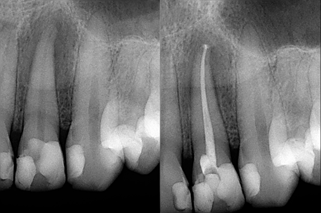 Root Canal Therapy